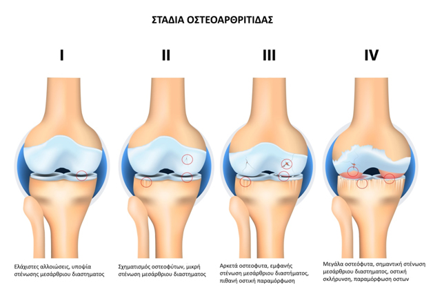 Αρθρίτιδα γόνατος - στάδια